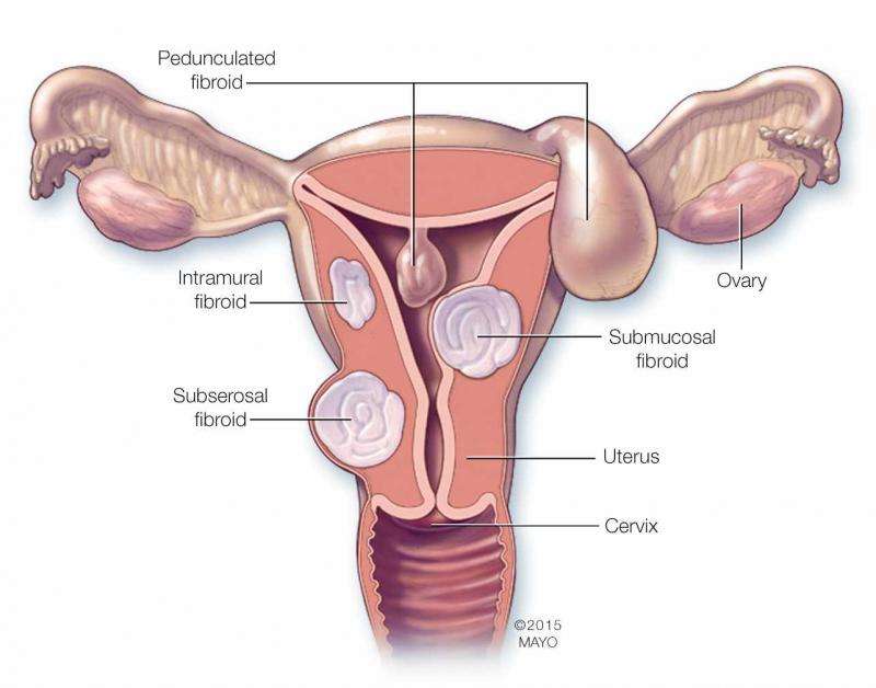 Exploring treatment options for women with fibroids