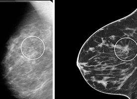 FDA approves high-tech breast imaging system