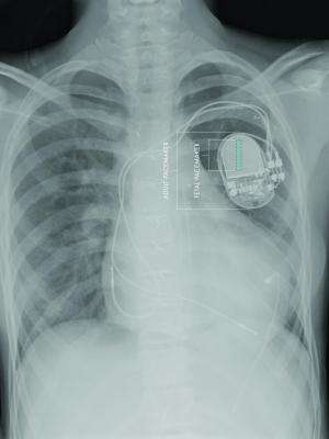 First fully-implantable micropacemaker designed for fetal use