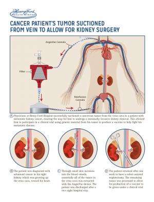 First-in man: Tumor suctioned from vein to allow minimally invasive kidney surgery