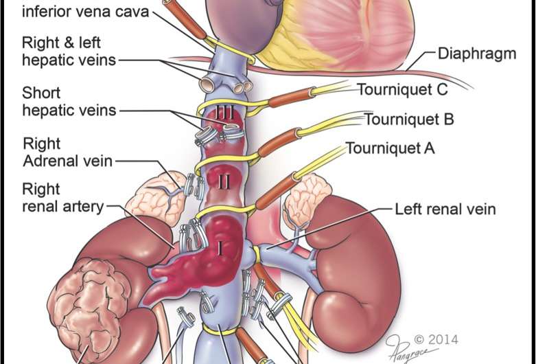 First reports of robotic surgery for advanced vena cava tumor thrombus due to kidney cancer