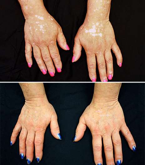 For vitiligo patient, arthritis drug restores skin color