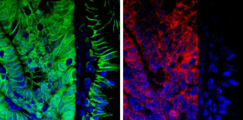 Gene pair plays crucial role in colon cancer, research shows