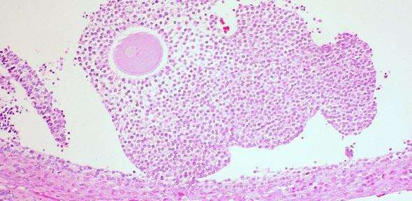 Greater understanding of polycystic ovary syndrome