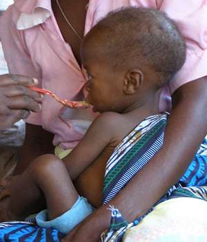 Gut microbes targeted for diagnosis, treatment of childhood undernutrition