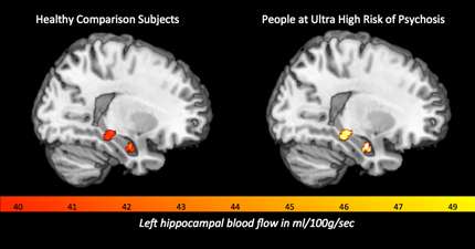 Heightened blood flow in the brain linked to development of psychosis