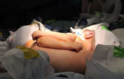 Hospital: Conjoined twin girls successfully separated