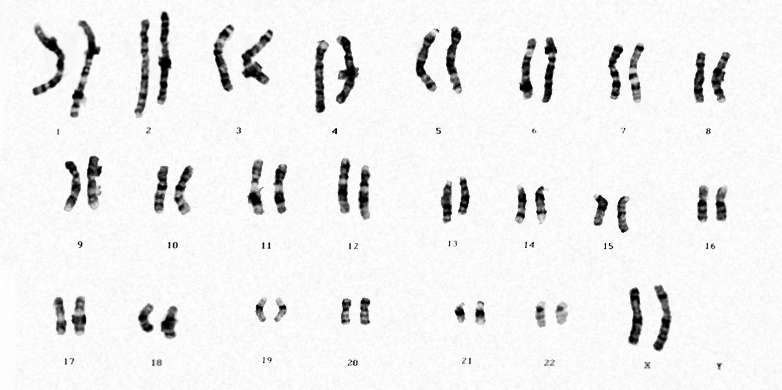 How a female X chromosome is inactivated