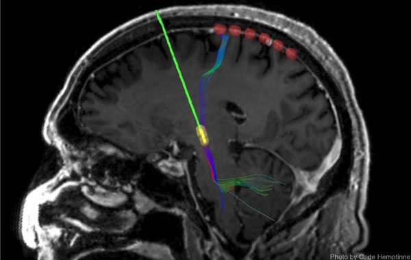 How deep-brain stimulation reshapes neural circuits in Parkinson's disease
