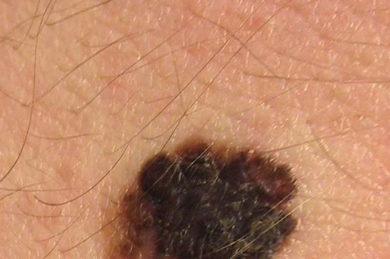 Hundreds of cancer possibilities arise from common skin mole mutation