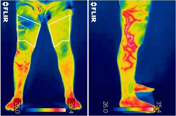Infrared thermography, a support tool for orthopedic diagnosis