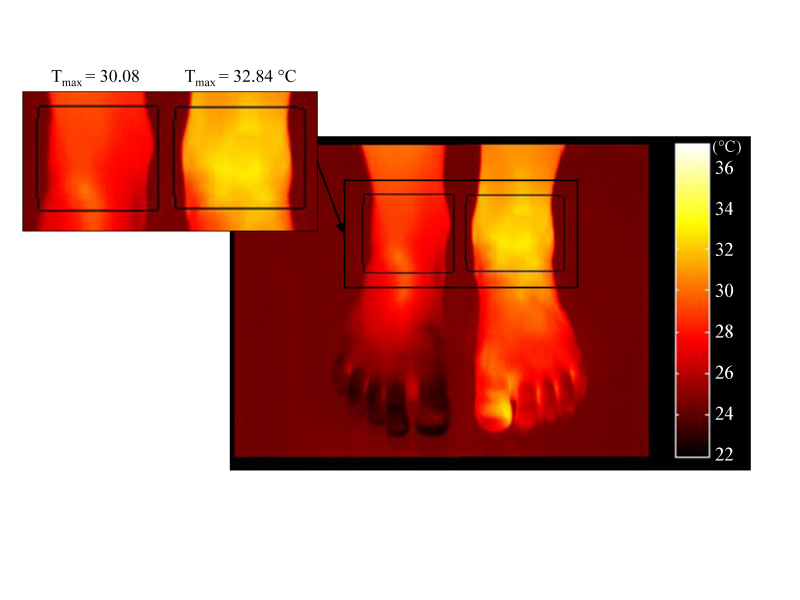Infrared thermography can detect joint inflammation and help improving work ergonomics