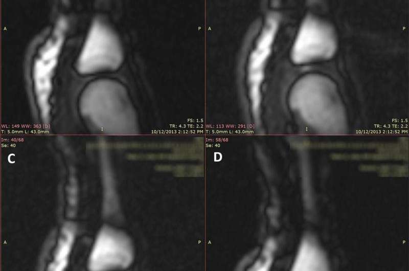 Knuckle-cracking observed using MRI