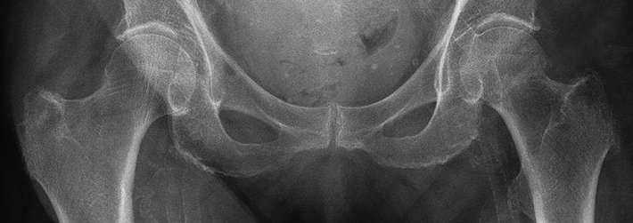 Lack of evidence on how to care for hip fracture patients with dementia