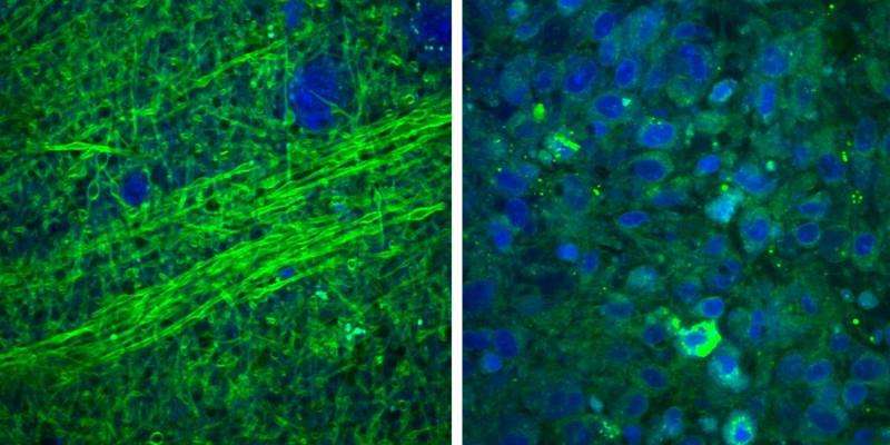 Laser-based imaging tool could increase accuracy, safety of brain tumor surgery