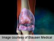 Leptin may mediate knee-related osteoarthritis