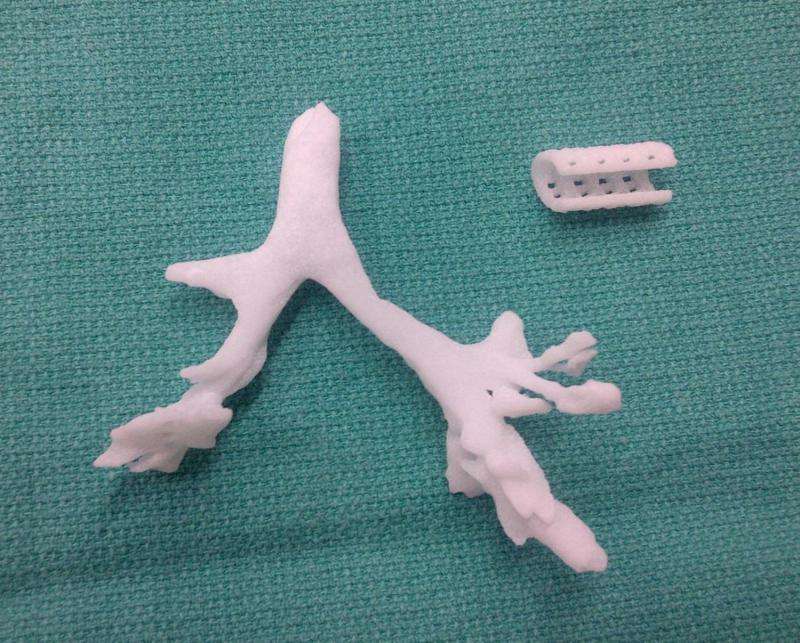 Life-saving, 3D-printed airway splint steps closer to market