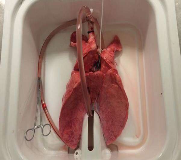 Lung 'filtering' technique can reduce transplant rejection