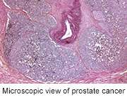 Many low-risk prostate cancer cases upgraded at prostatectomy