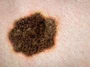 Many skin cancer patients skip routine self-exams