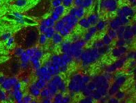 Metformin use may not improve pancreatic cancer survival