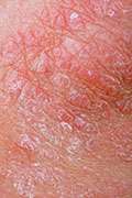 Misconceptions of infection, contagion surround psoriasis