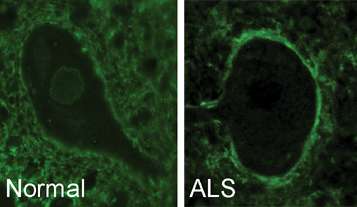 Mixed up cell transportation key piece of ALS and dementia puzzle