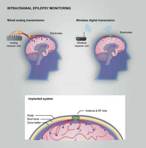Monitoring epilepsy in the brain with a wireless system