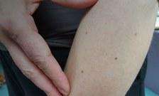 More than 11 moles on your arm could indicate higher risk of melanoma