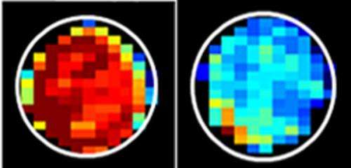 MRI based on a sugar molecule can tell cancerous from noncancerous cells