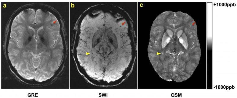MRI improves diagnosis of microbleeding after brain injury in military personnel