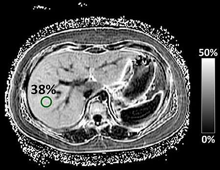 MRI technique developed for nonalcoholic fatty liver disease in children
