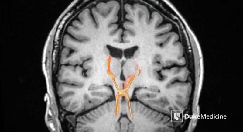 MRI technology reveals deep brain pathways in unprecedented detail