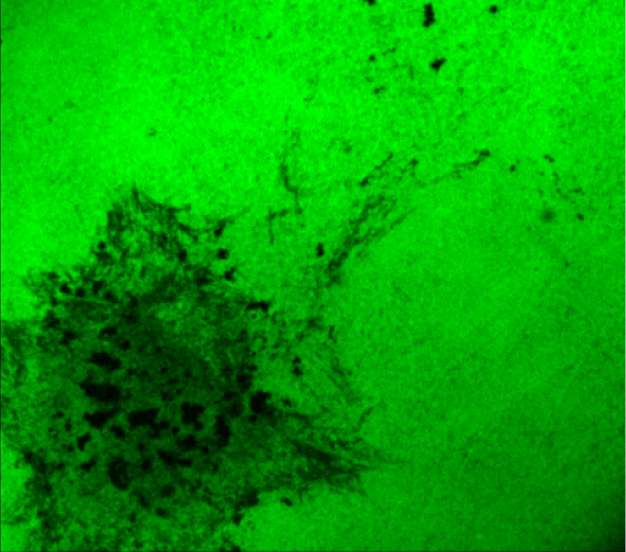 Neutrophil and cancer cell 'crosstalk' underlies oral cancer metastasis