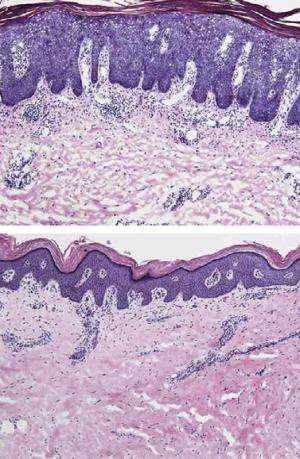New antibody therapy dramatically improves psoriasis symptoms in clinical trial