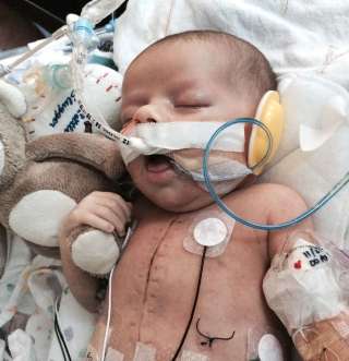 Newborn with heart defect saved after 13-hour operation