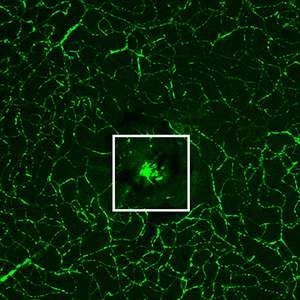 New clues found to vision loss in macular degeneration?