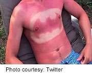 New dumb-but-deadly trend: sunburn 'Art'