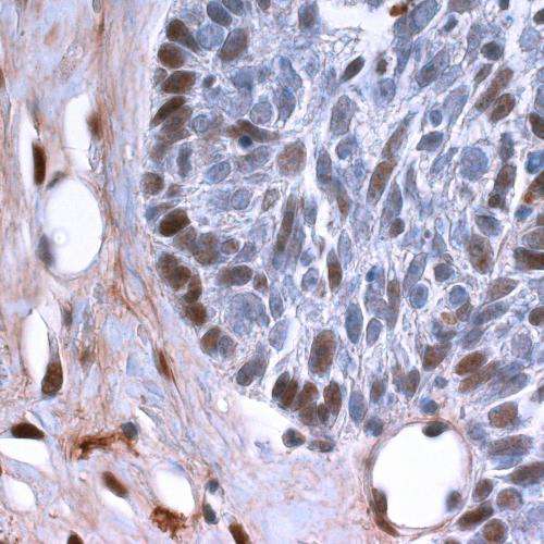 New mechanism involved in skin cancer initiation, growth and progression