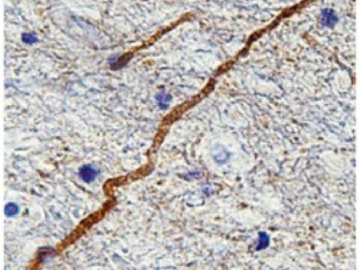 New protein biomarker identifies damaged brain wiring after concussion