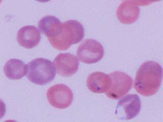New research helps explain why a deadly blood cancer often affects children with malaria