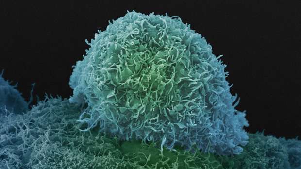 New role for prostate cancer protein could lead to better diagnosis and treatment