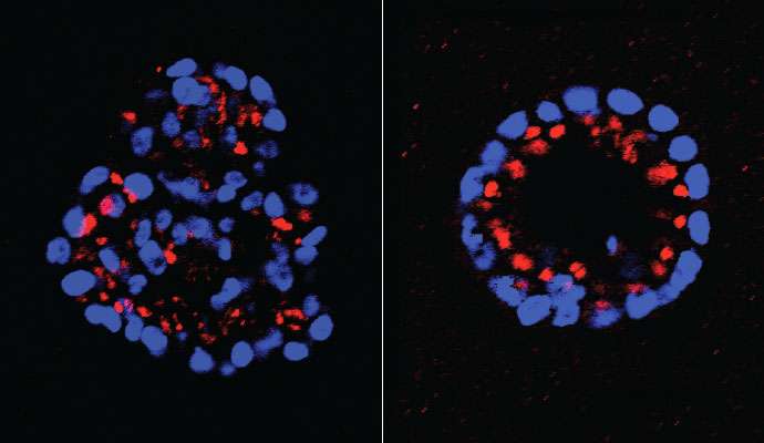 New signaling pathway discovered in HER2-positive breast cancer, and 2 powerful drug targets