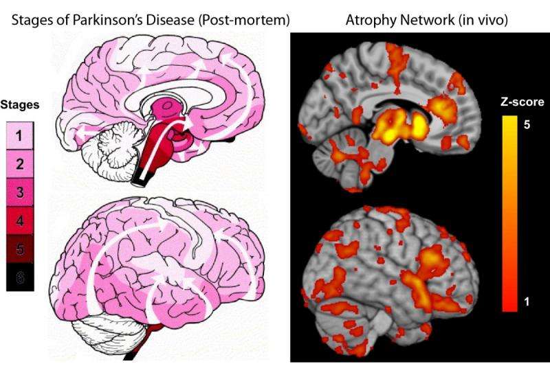 New study maps the progression of Parkinson's disease within the brain