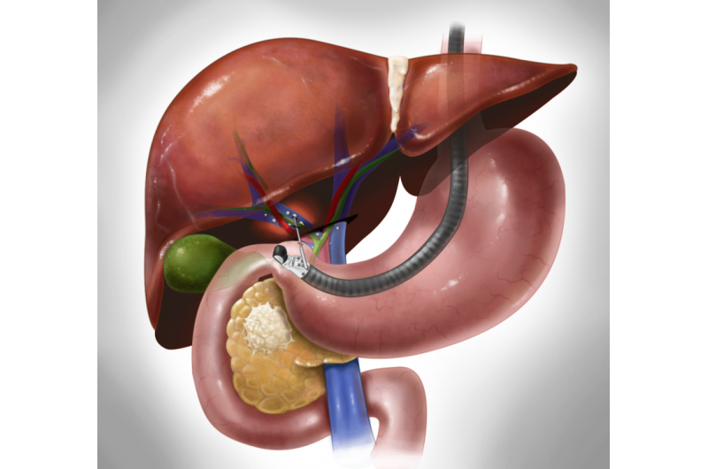 New test may improve diagnosis and treatment of pancreactic cancers