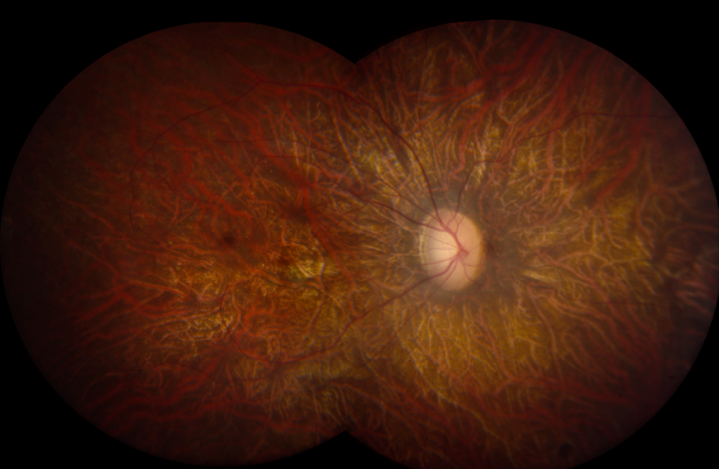 NIH-funded study points way forward for retinal disease gene therapy