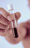 Non-O blood group tied to higher CAD, MI risk