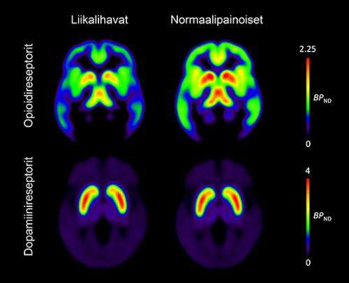 Obesity is associated with brain's neurotransmitters