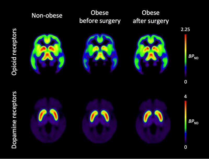 Obesity surgery normalizes brain opioids