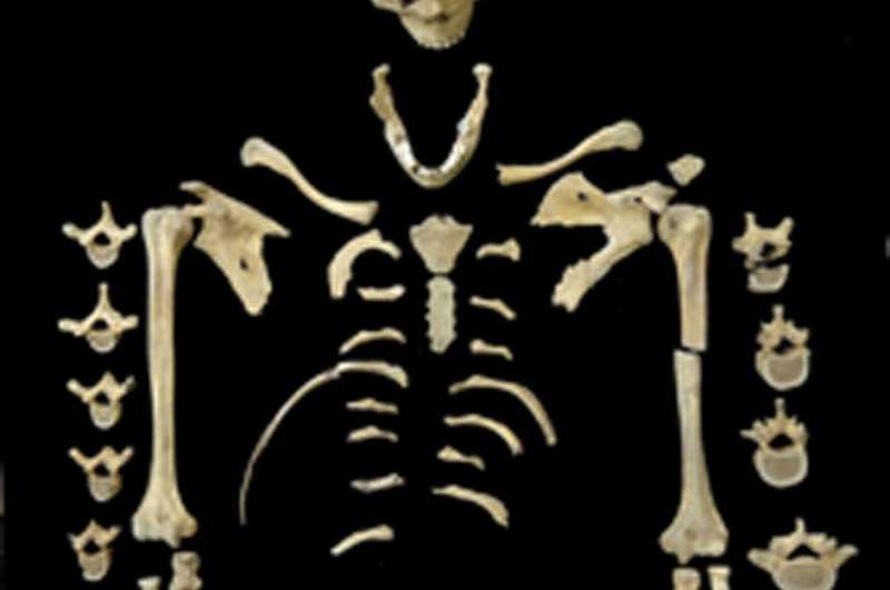 Oldest case of leukemia discovered—prehistoric female skeleton shows signs of this cancer